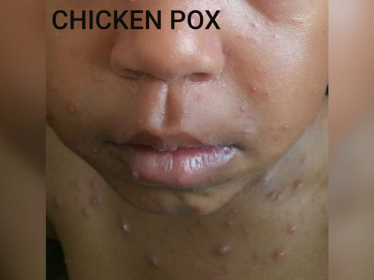 CHICKENPOX