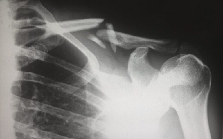 FRACTURES IN CHILDREN