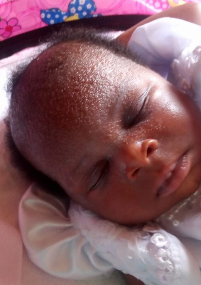 Heat Rashes in Children