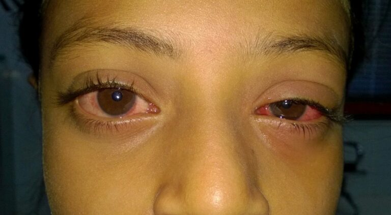 “APOLLO”  – Red eyes in children