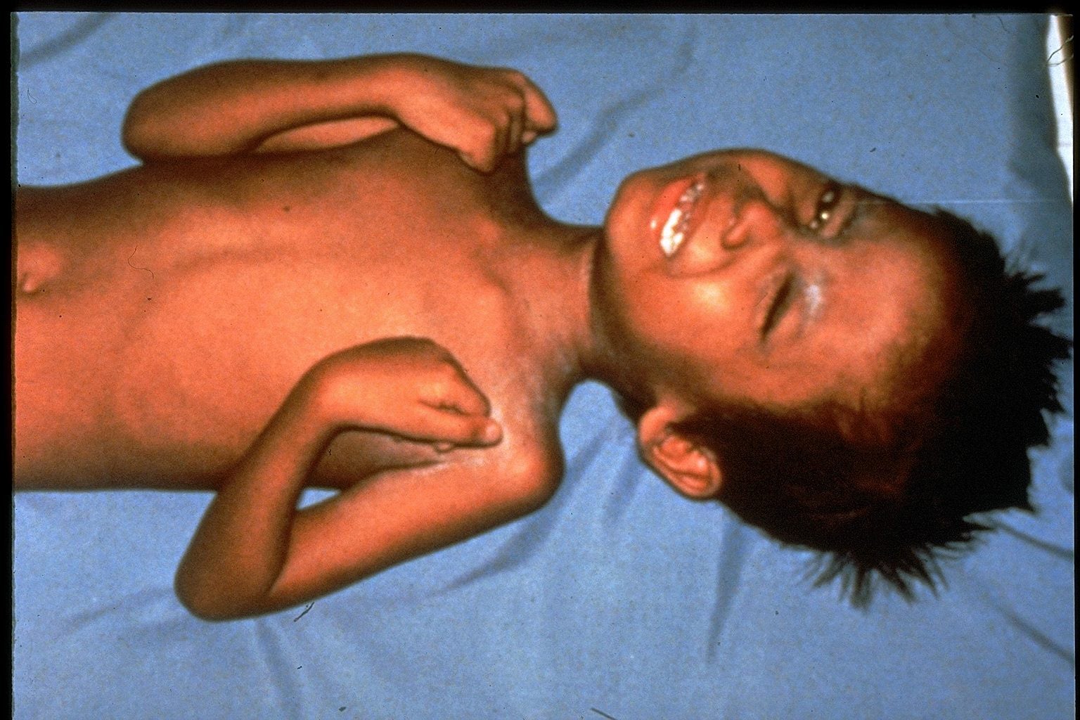 
Tetanus in Children